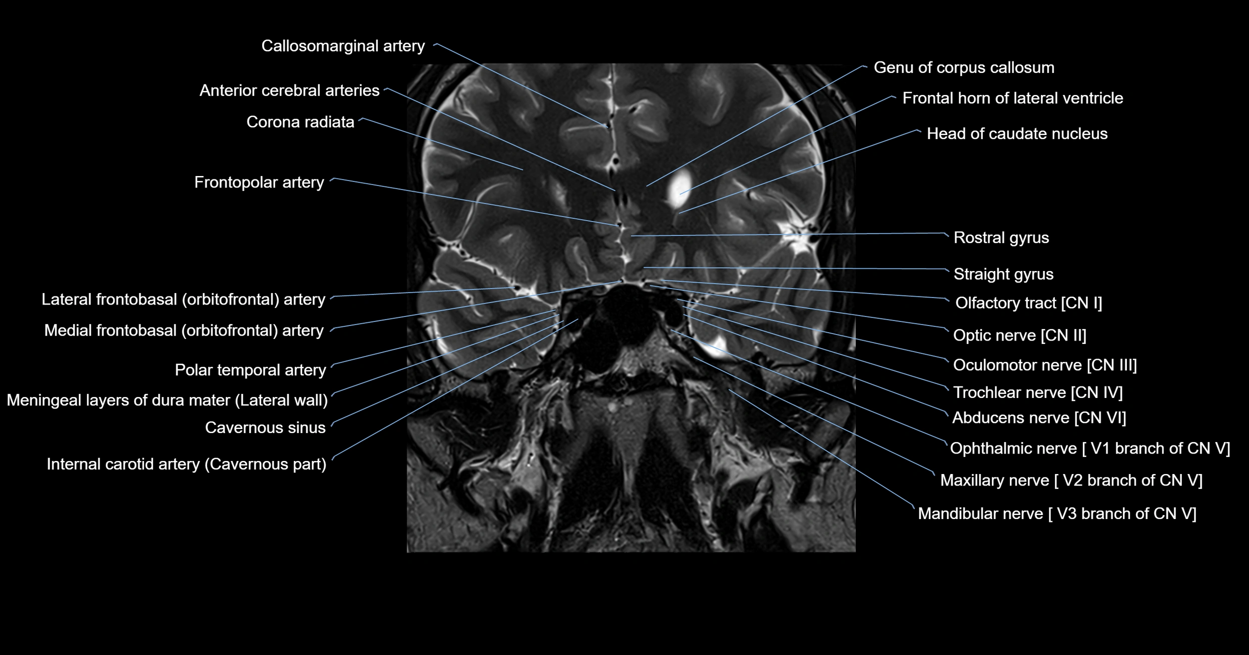 MRI brainstem & basal ganglia anatomy labelled 3T MRI images -img-00001-00006.webp